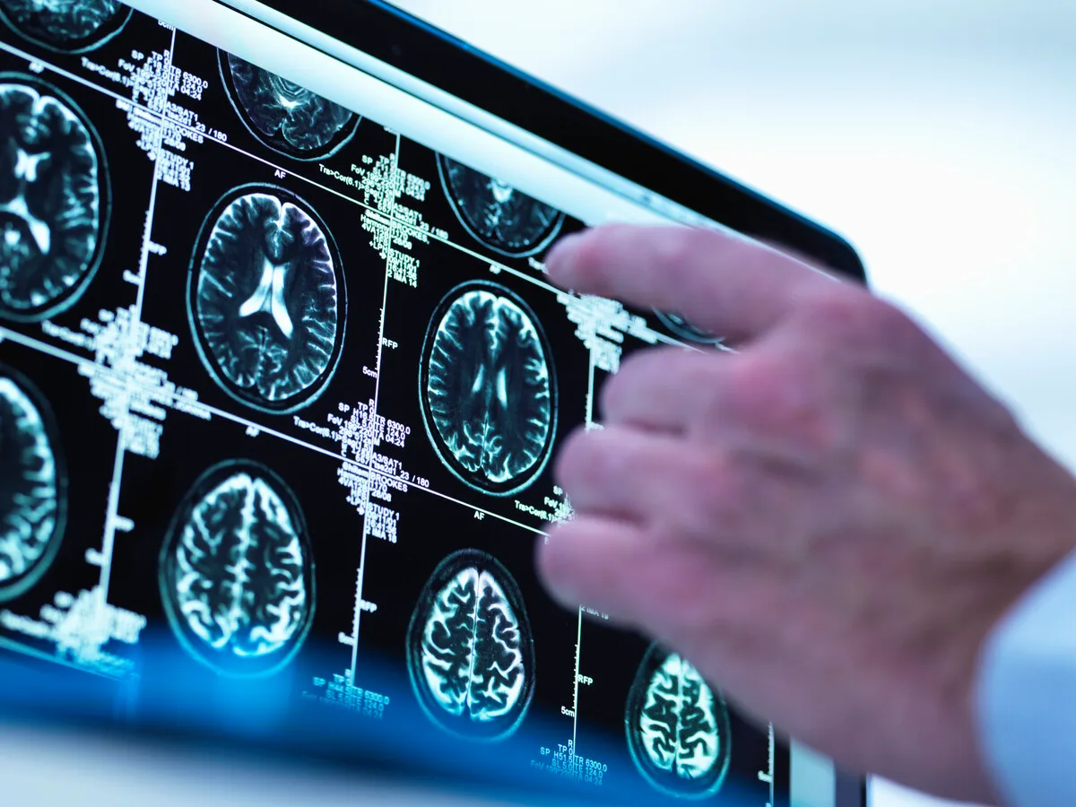 Mà assenyalant ressonàncies cerebrals en monitor; avenços tecnològics alzhèimer.